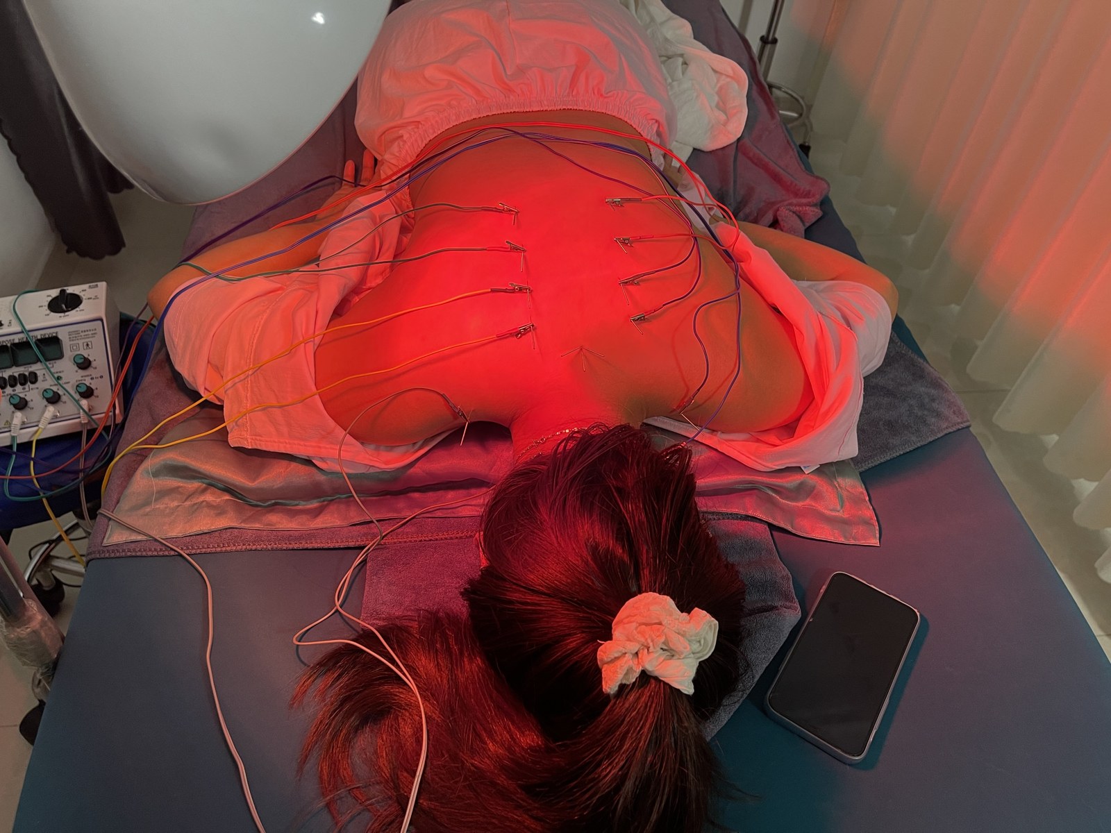 Điện châm kết hợp đèn hồng ngoại tại CTM